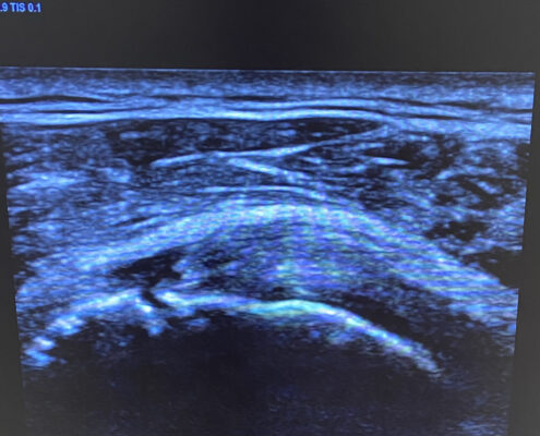 rotura insercional tendon supraespinoso